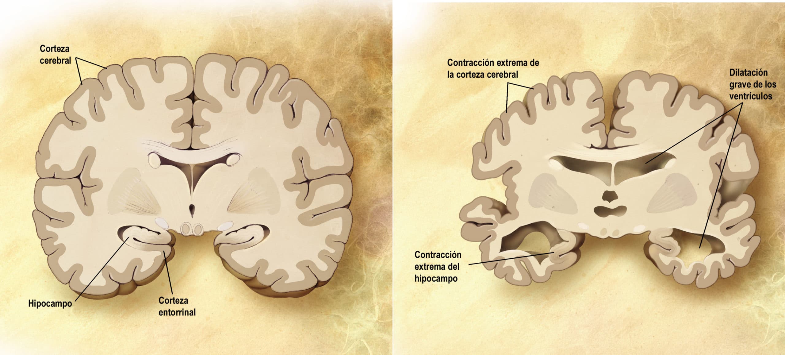 Cerebro corte frontal Alzheimer